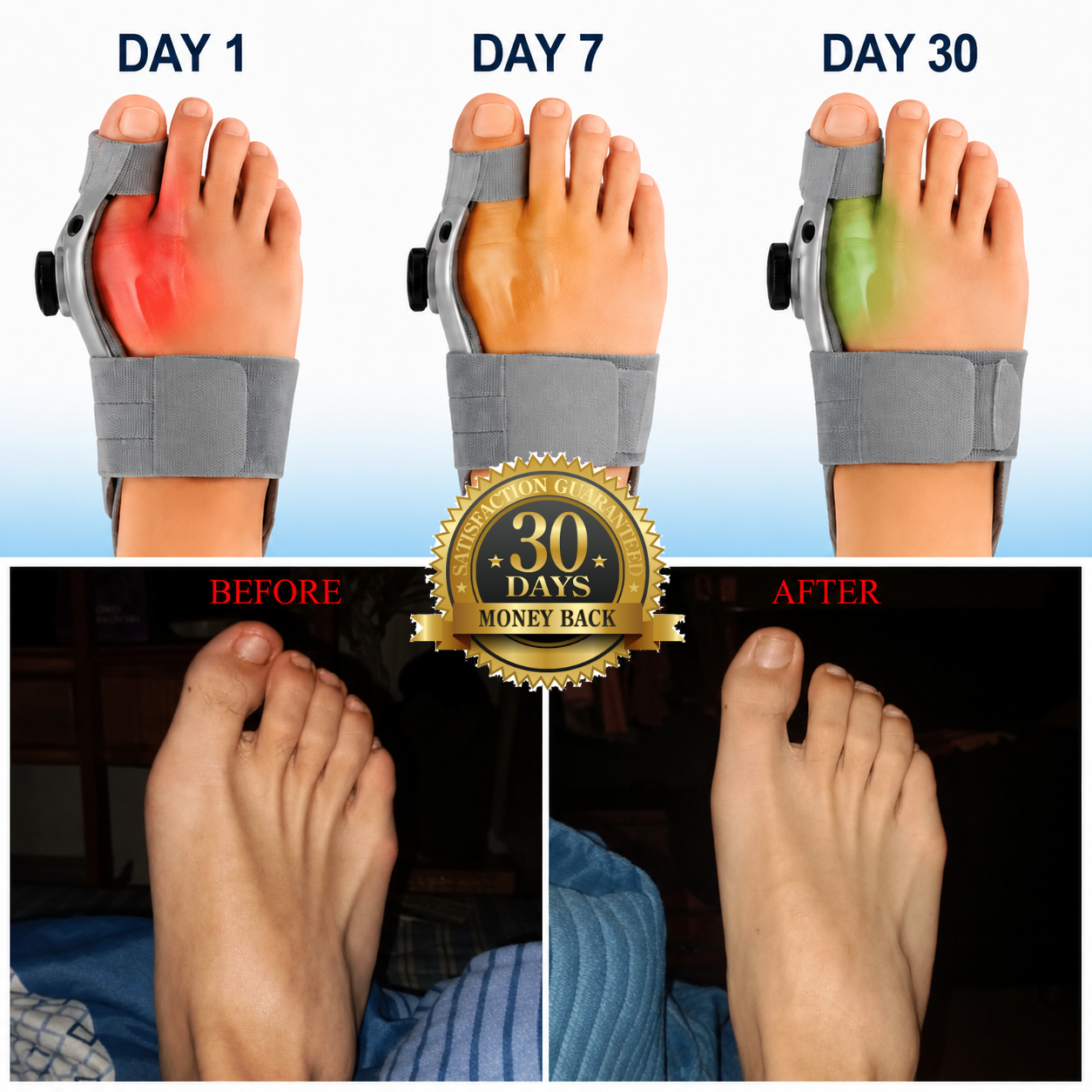 Bunion Corrector
